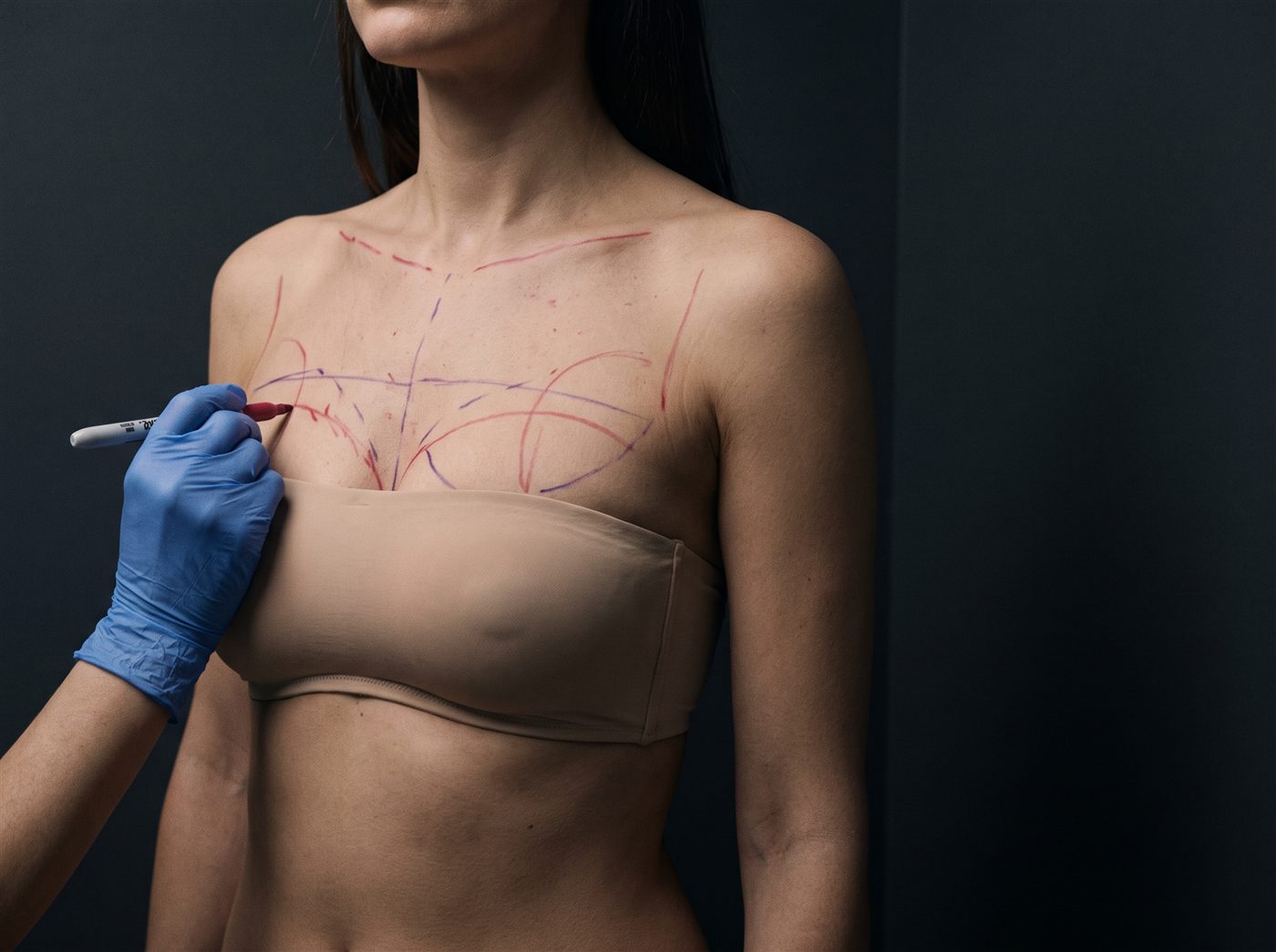 Breast augmentation at CFH