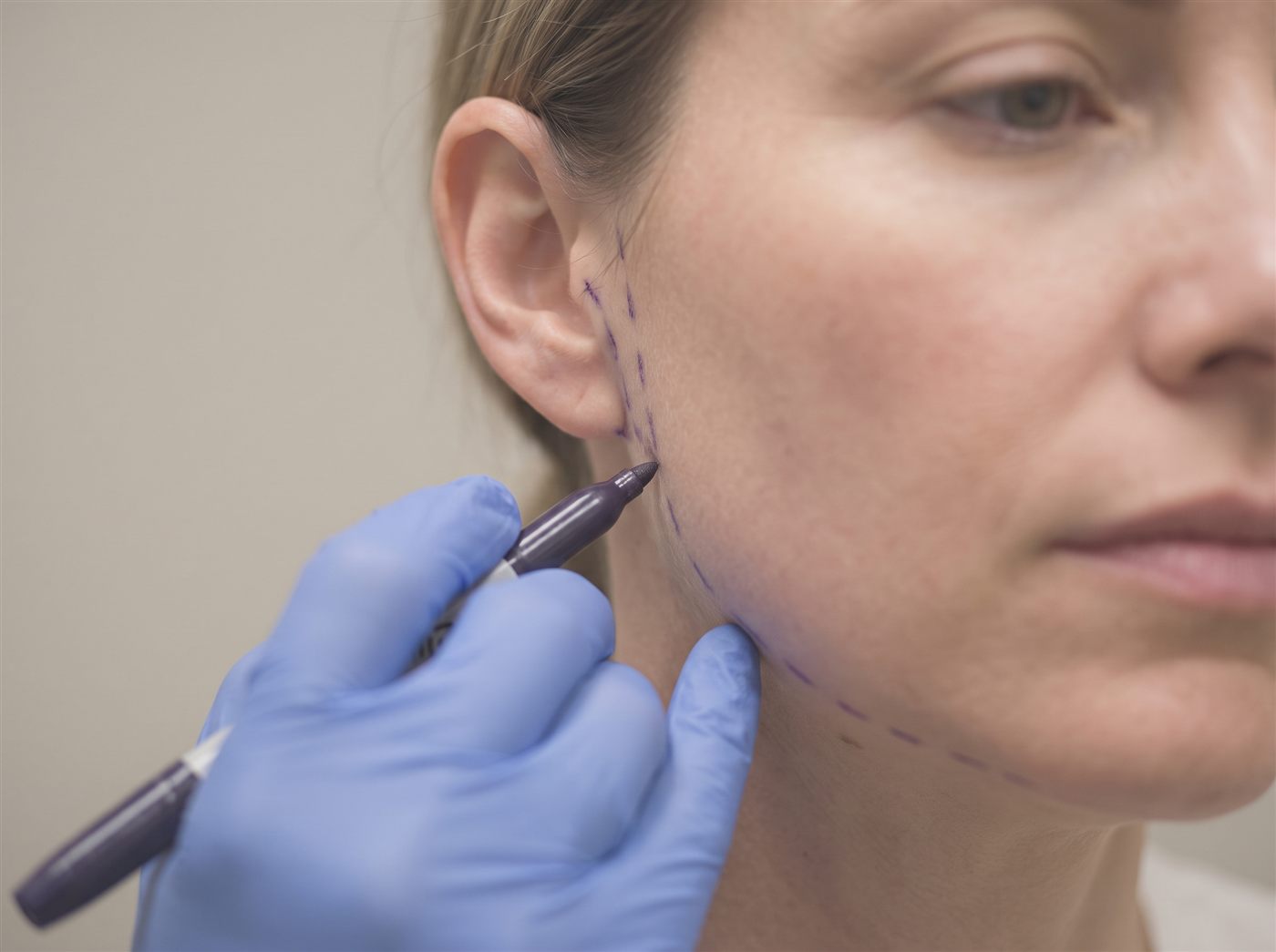Deep-plane facelift at CFH