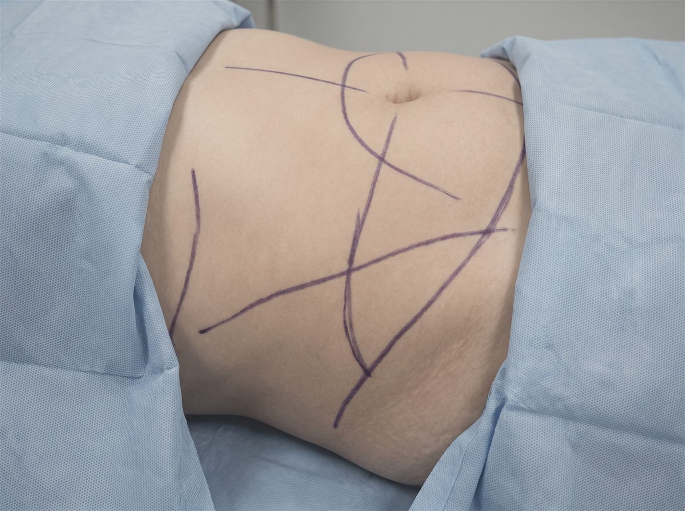 Liposculpture at CFH