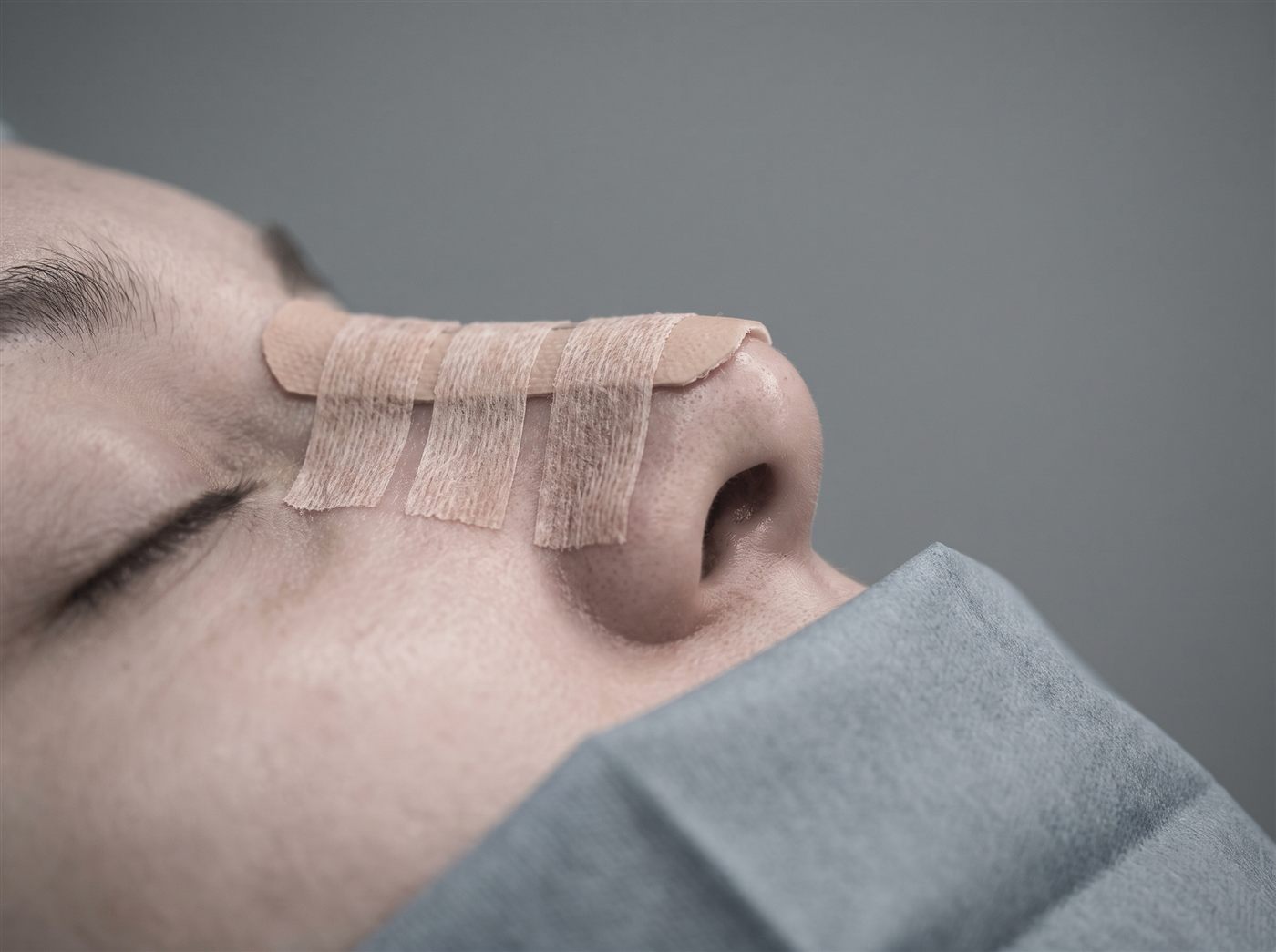 Structural rhinoplasty at CFH